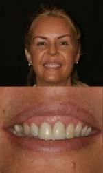 Before, Gummy Smile Correction, Tiffin