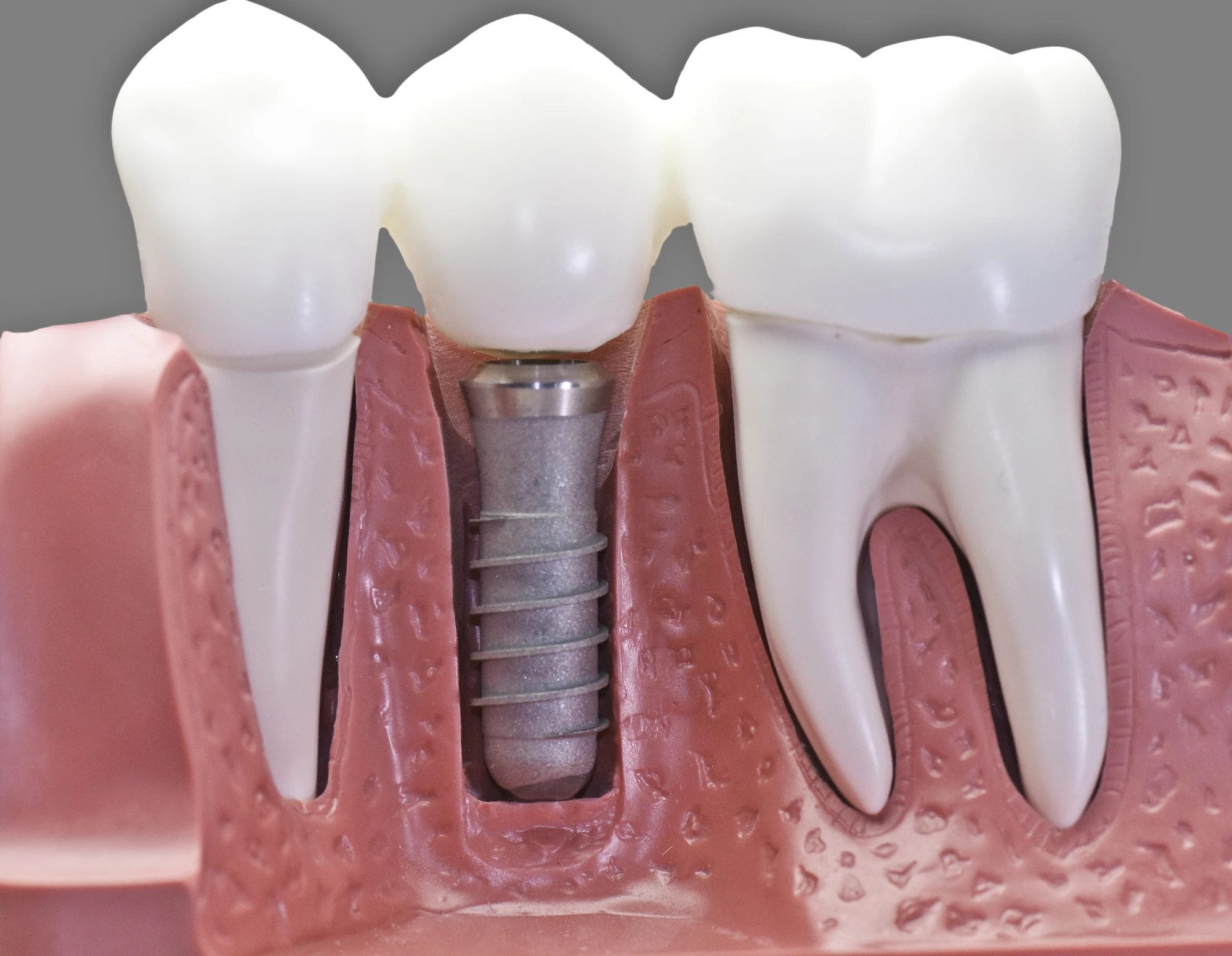 Dr. Gleave discussing dental implant treatment with a patient
