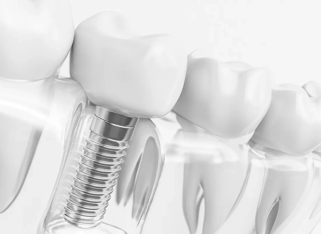 Dental Implant Posts Can Improve Your Oral Health