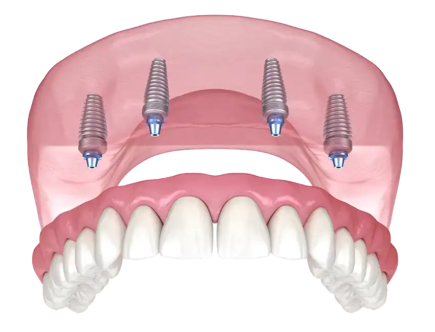 After Getting A Full Arch Of Teeth Extracted, Should I Get Treated With Full Mouth Dental Implants?