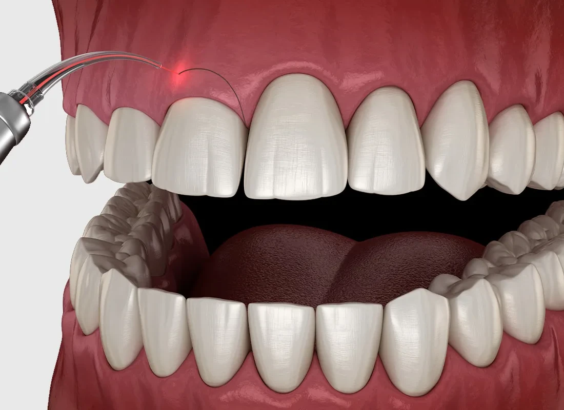 What is Crown Lengthening