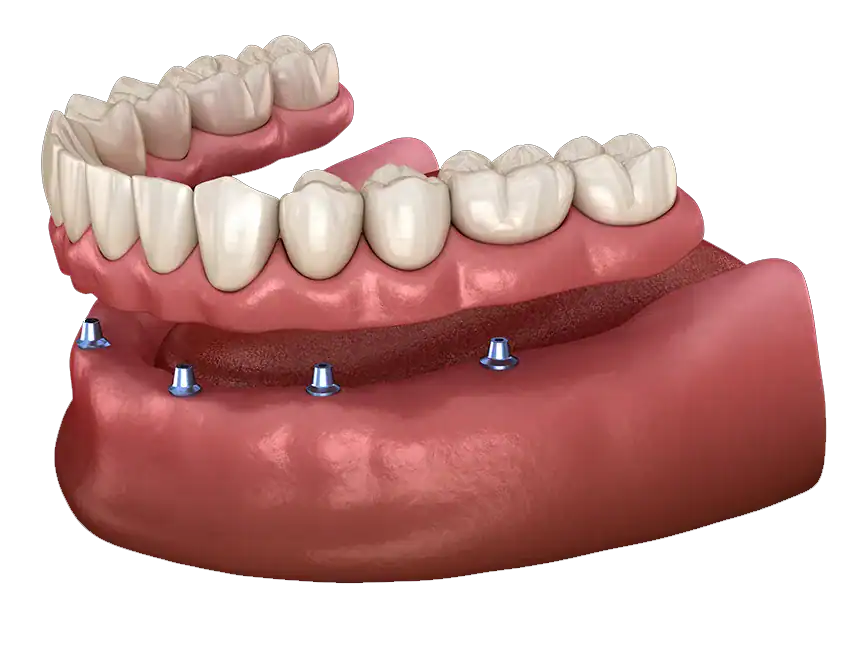 LOCATOR implant overdenture model