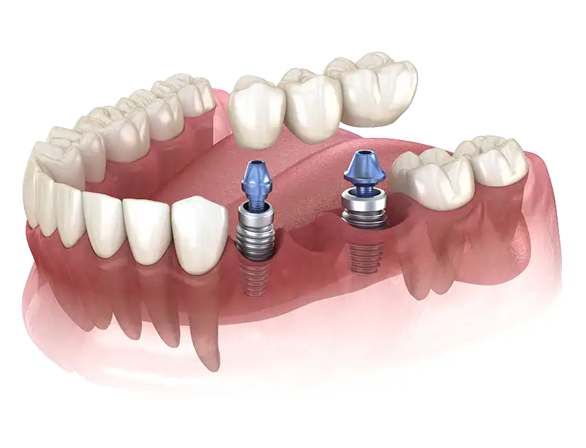 What Is The Recovery Time For Dental Implants?