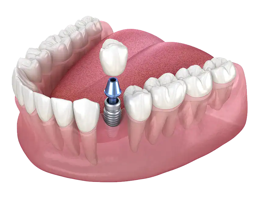 Although Every Person’s Smile Is Unique, What Does A Typical Multiple Dental Implant Procedure Look Like?