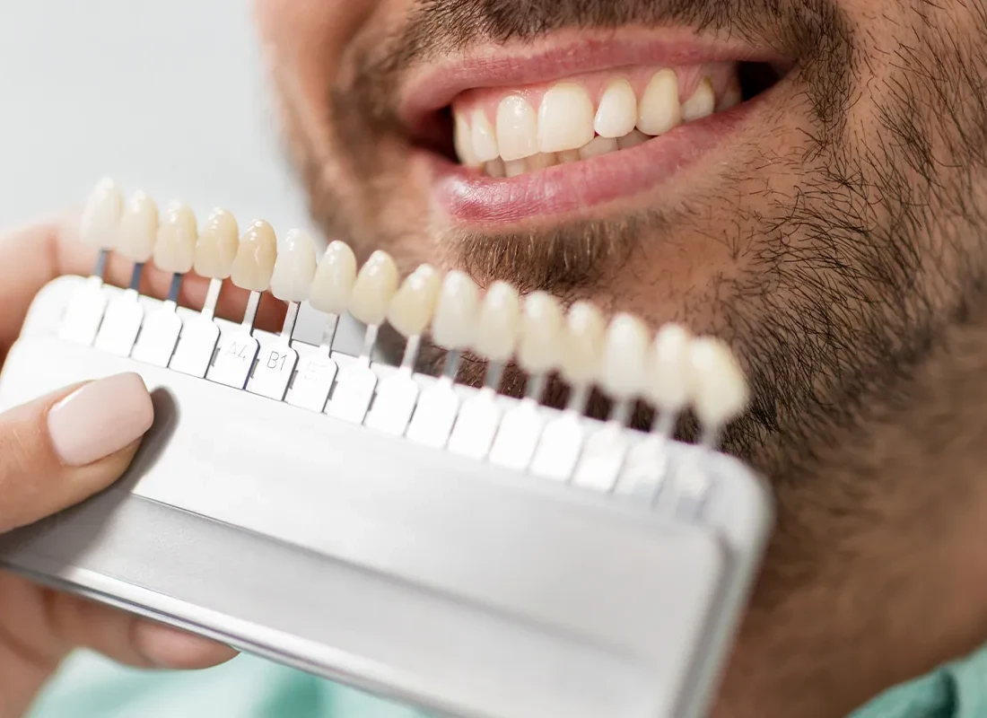 Signs you may need teeth whitening