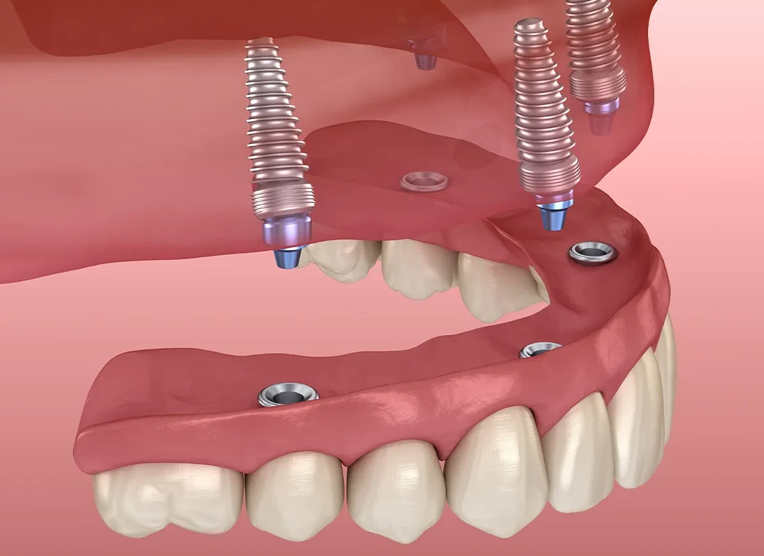 How Can Full Mouth Dental Implants Benefit Me?