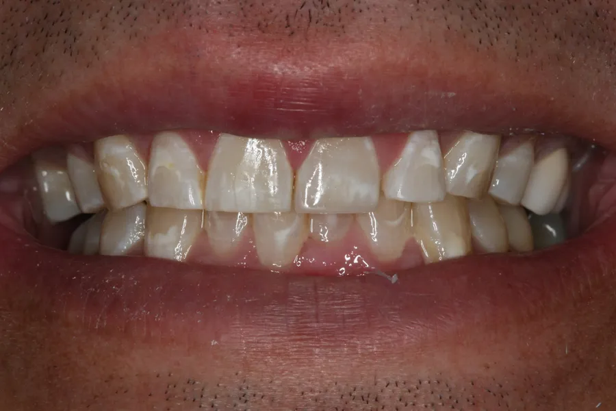 After, Fractured Teeth, Composite Bonding: Bobby