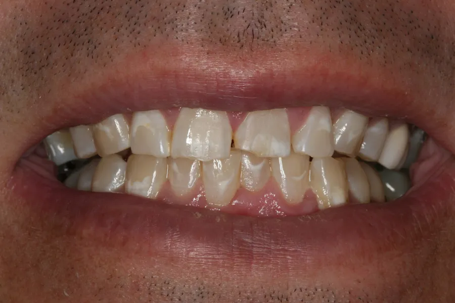 Before, Fractured Teeth, Composite Bonding: Bobby