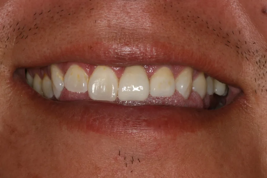 After, Two Fractured Teeth Restored: Brad