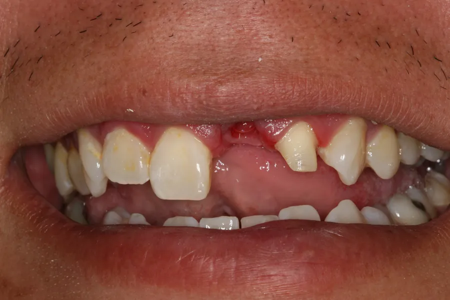 Before, Two Fractured Teeth Restored: Brad