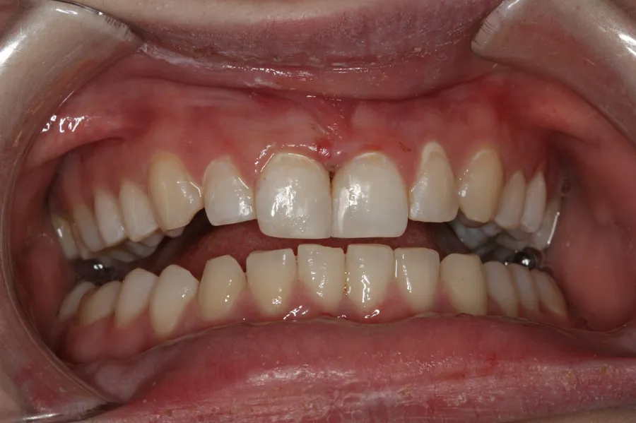After, Fractured Tooth, Composite Bonding: Breanna