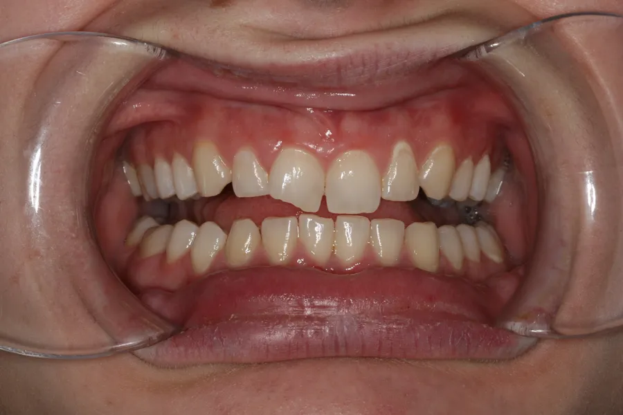 Before, Fractured Tooth, Composite Bonding: Breanna
