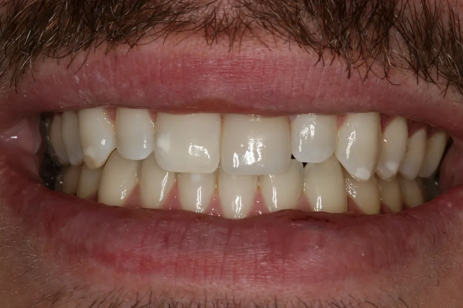 After, Fractured Tooth, Porcelain Veneer: Caz