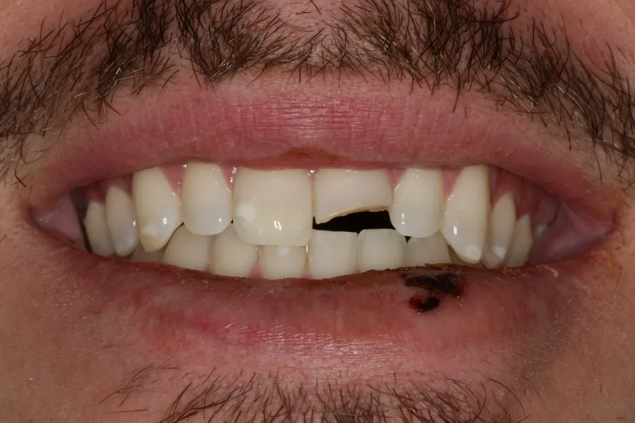 Before, Fractured Tooth, Porcelain Veneer: Caz
