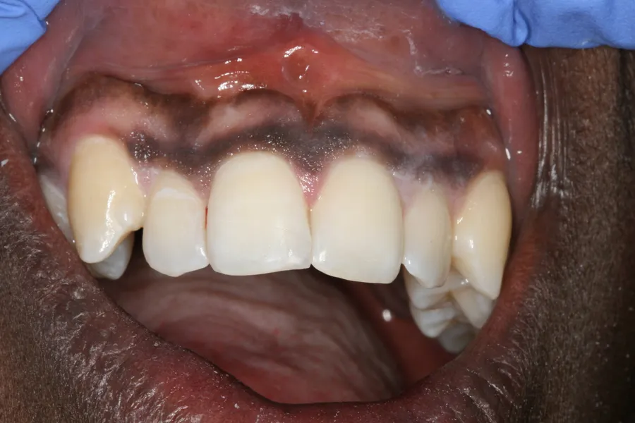 After, Fractured Tooth, Composite Bonding: Daron