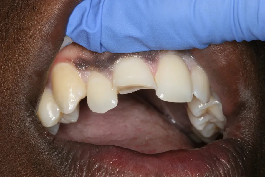 Before, Fractured Tooth, Composite Bonding: Daron
