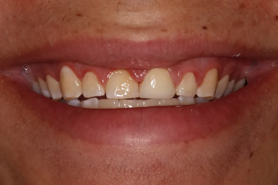 After, Fractured Tooth, Root Canal, Post & Crown: Issac