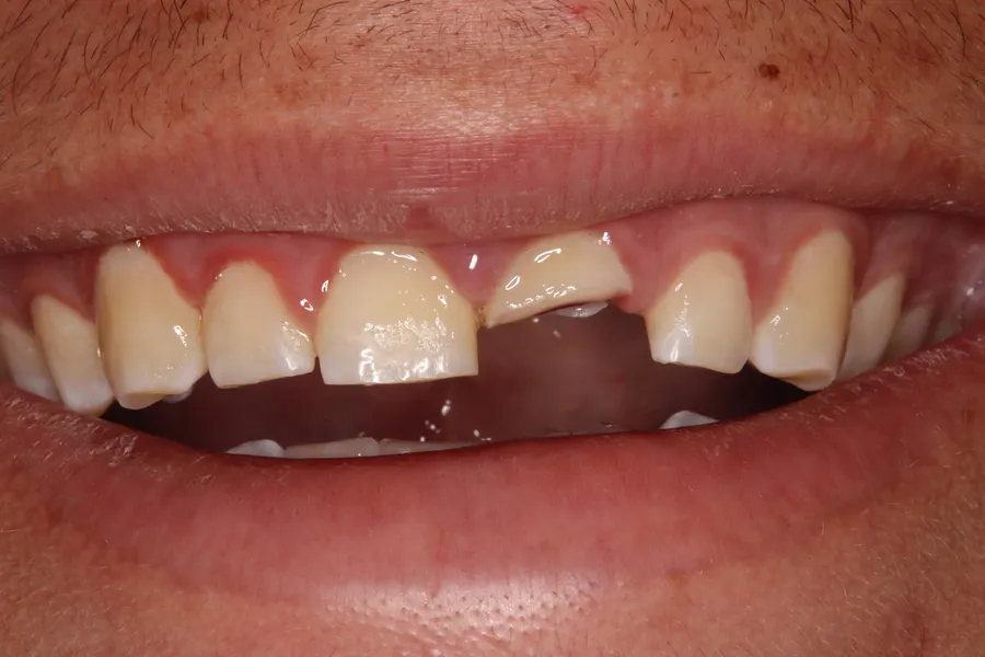 Before, Fractured Tooth, Root Canal, Post & Crown: Issac