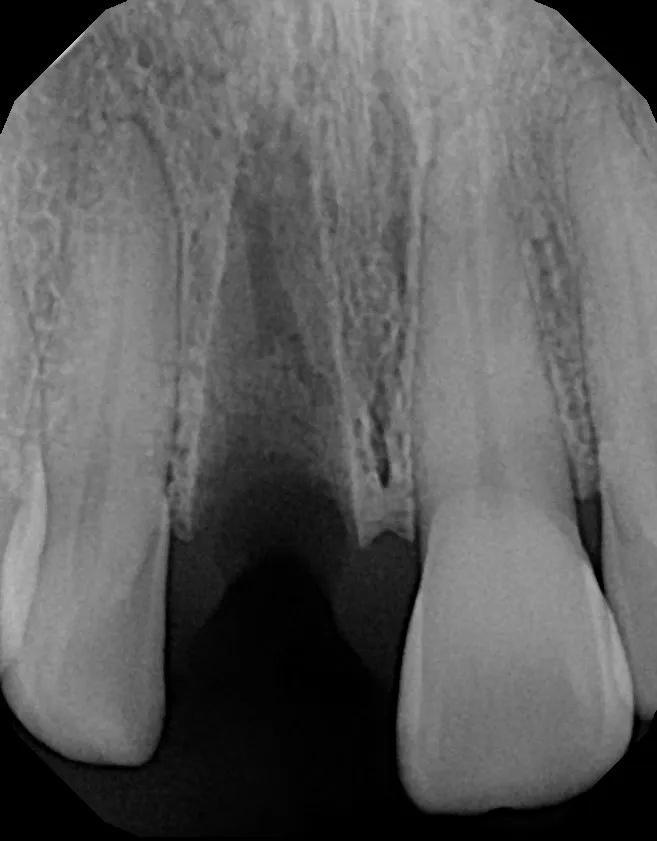 X-ray at the emergency visit: Knocked-Out Tooth, Splinted & Bonded: Jessica