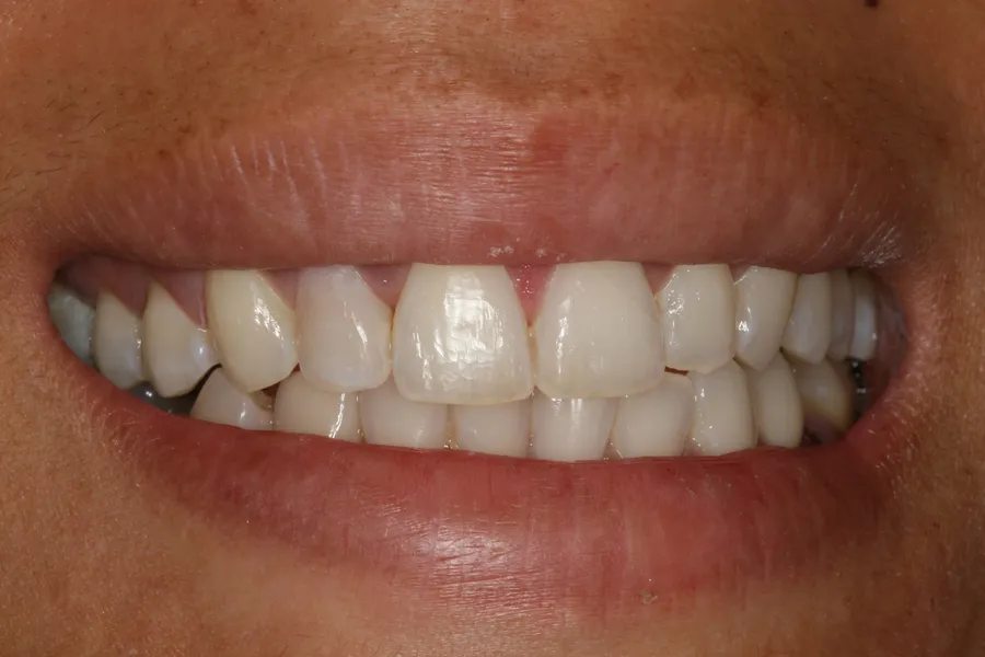 After, Knocked-Out Tooth, Splinted & Bonded: Jessica