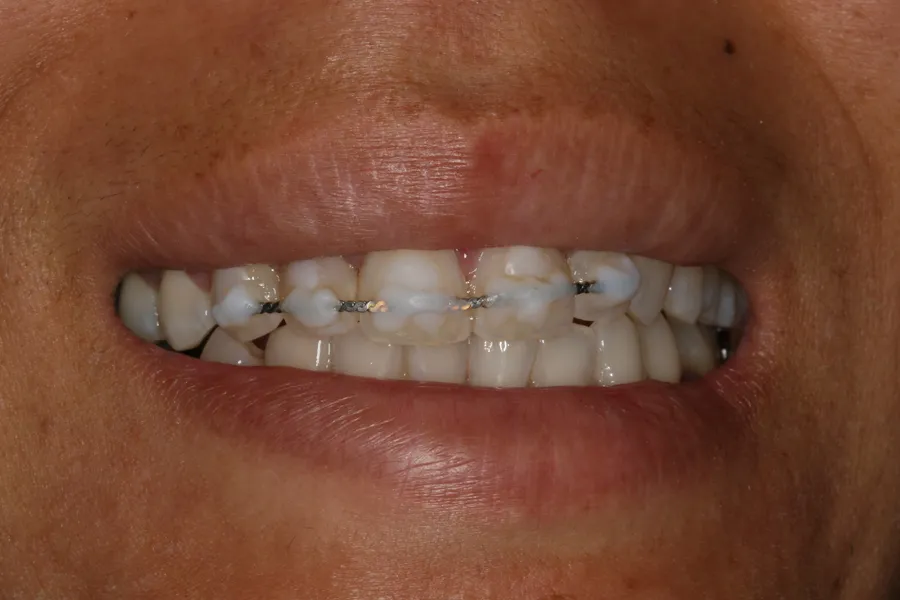 Before, Knocked-Out Tooth, Splinted & Bonded: Jessica