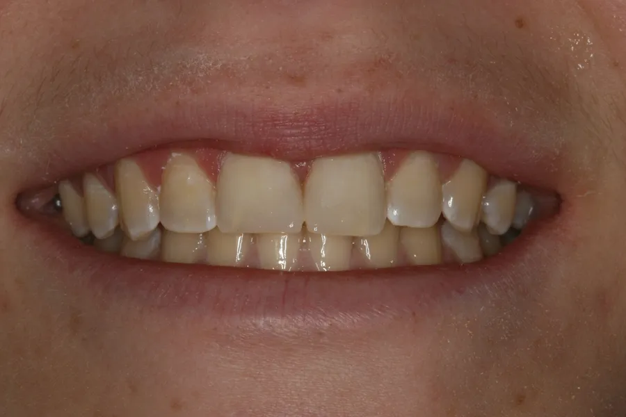 After, Fractured Tooth, Composite Bonding: Maggie