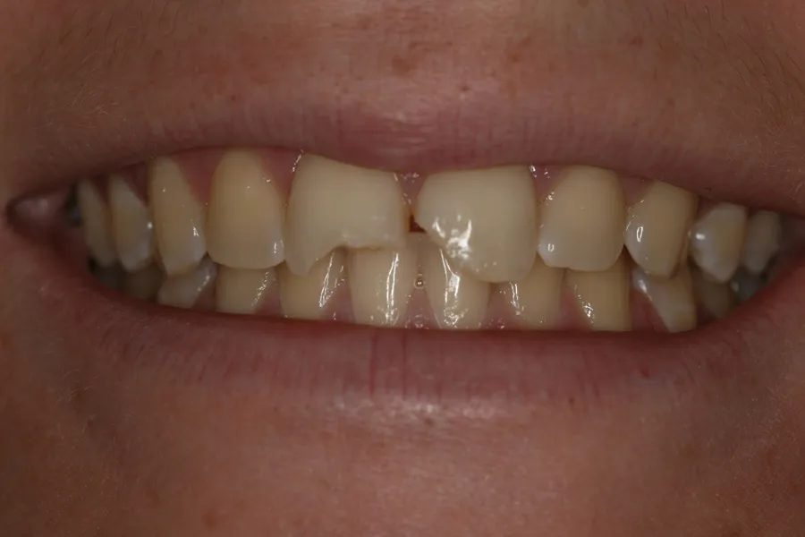 Before, Fractured Tooth, Composite Bonding: Maggie