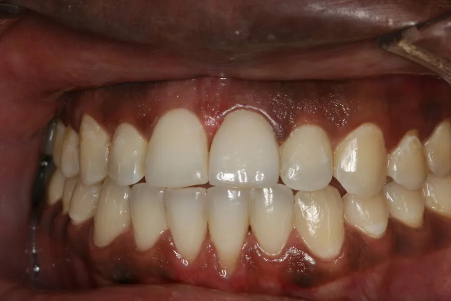 After, Fractured Tooth, Porcelain Veneer: Nasir