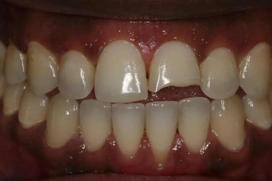 Before, Fractured Tooth, Porcelain Veneer: Nasir