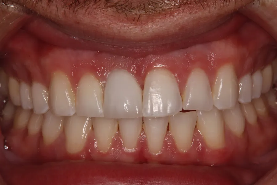 After, Fractured Root → Same-Day Implant: Nick
