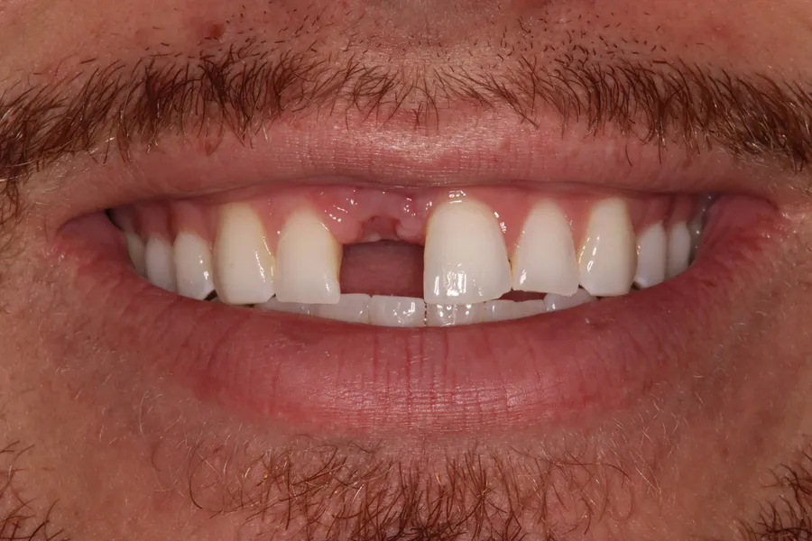 Before, Fractured Root → Same-Day Implant: Nick