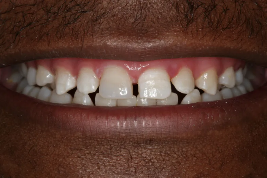 After, Fractured Front Tooth, Same-Day Bonding: Tabo