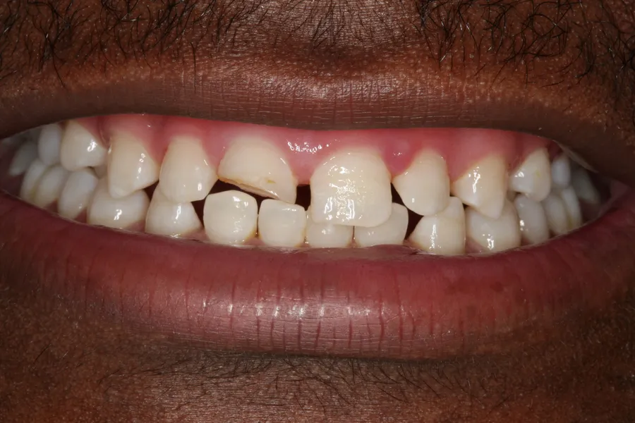 Before, Fractured Front Tooth, Same-Day Bonding: Tabo