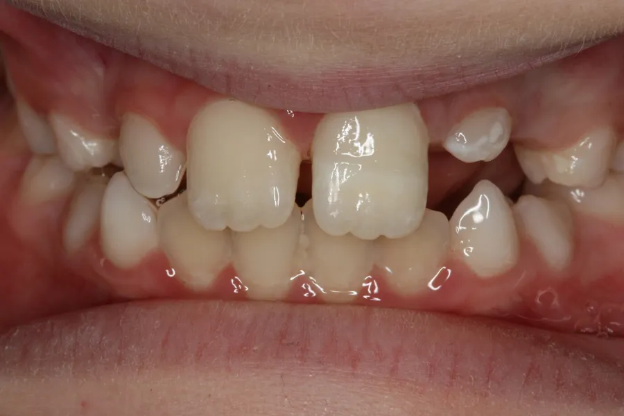 After, Fractured Tooth Rebonded: Zach