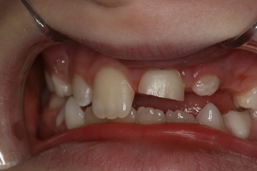 Before, Fractured Tooth Rebonded: Zach