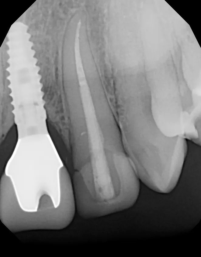 X-ray of the completed implant: Emergency Implant + Crown: Brad