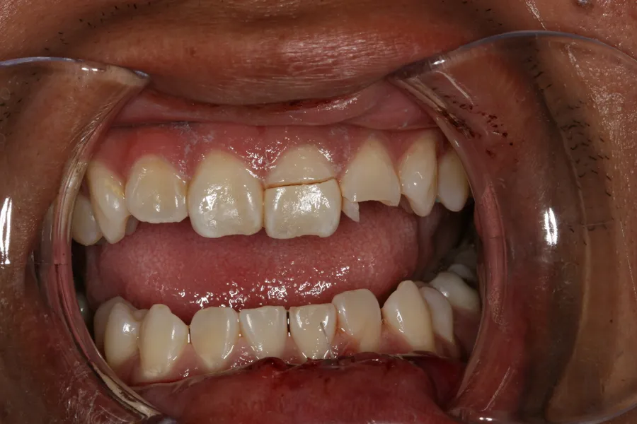 Before, Emergency Implant + Crown: Brad
