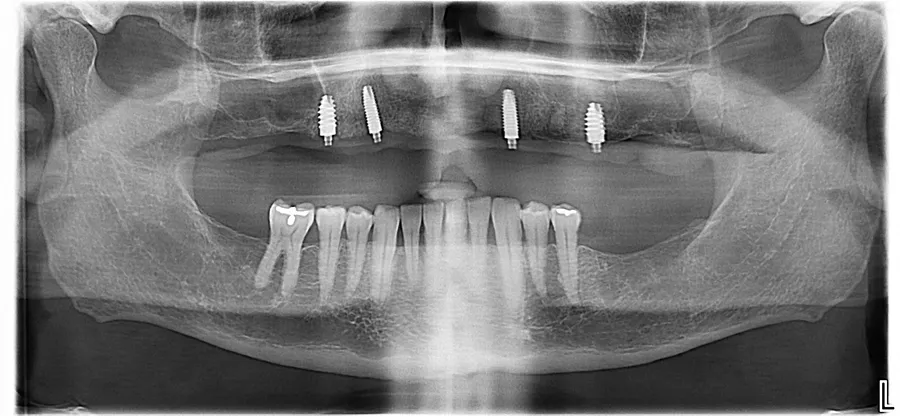 Panoramic X-ray, after: Fixed Full-Arch on 4 Implants: Bryan