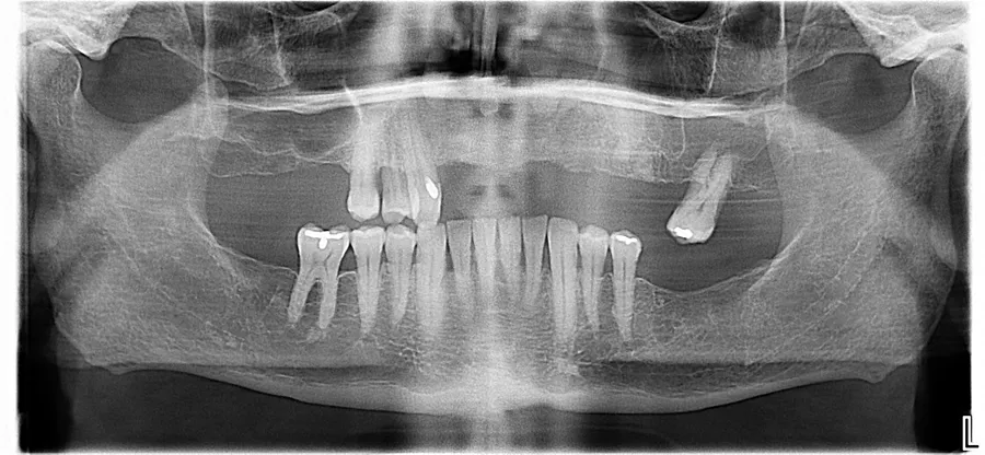 Panoramic X-ray, before: Fixed Full-Arch on 4 Implants: Bryan