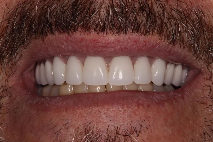 After (close-up), Fixed Full-Arch on 4 Implants: Bryan
