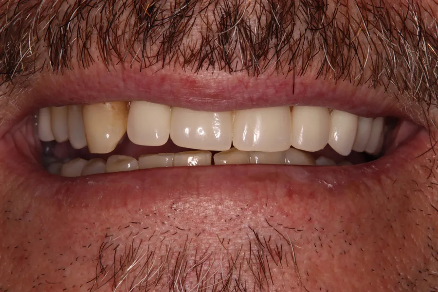 Before (close-up), Fixed Full-Arch on 4 Implants: Bryan