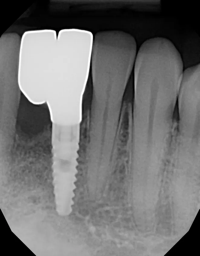 X-ray of the implant: Implant Cantilever Bridge: Candice