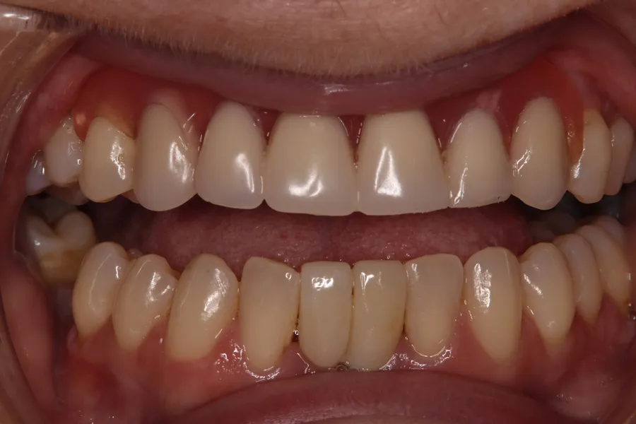 After, Implant Cantilever Bridge: Candice