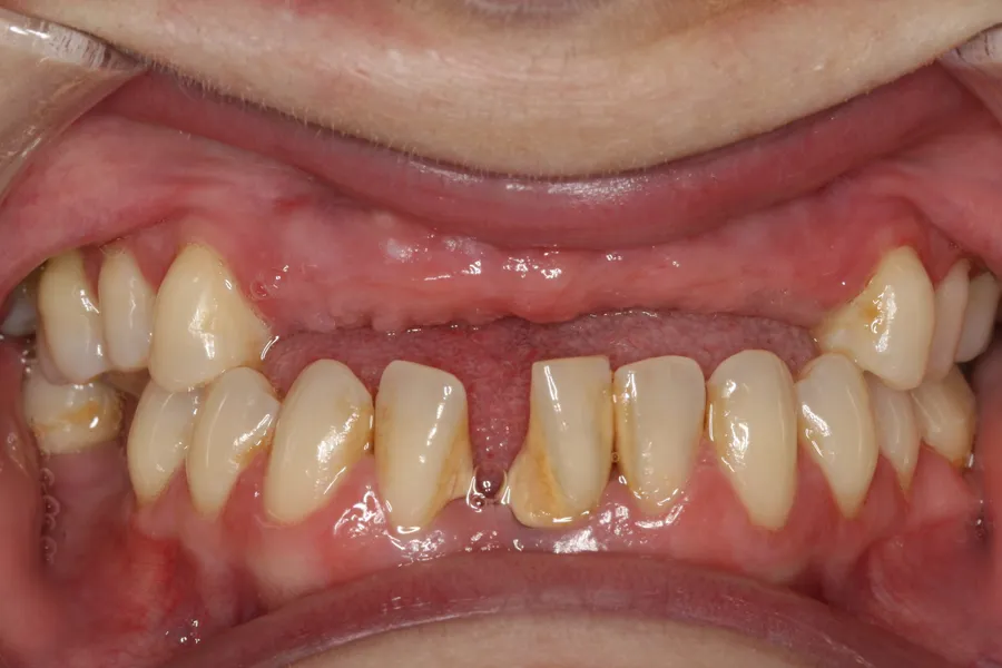 Before, Implant Cantilever Bridge: Candice