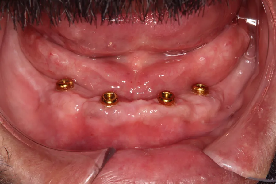 Locator attachments on the implants: Locator Denture + Fixed Bridges: Danny