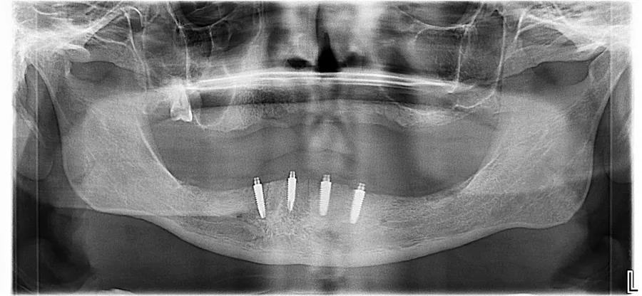 Panoramic X-ray, after: Locator Denture + Fixed Bridges: Danny