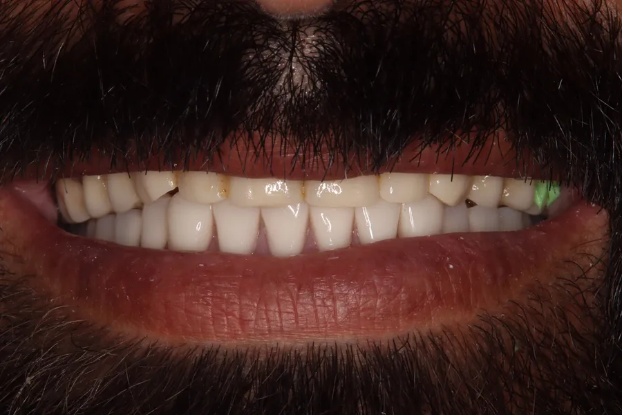 After, Locator Denture + Fixed Bridges: Danny