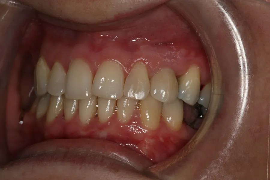 Retracted view, after: Missing Cuspid Replaced: Hailey