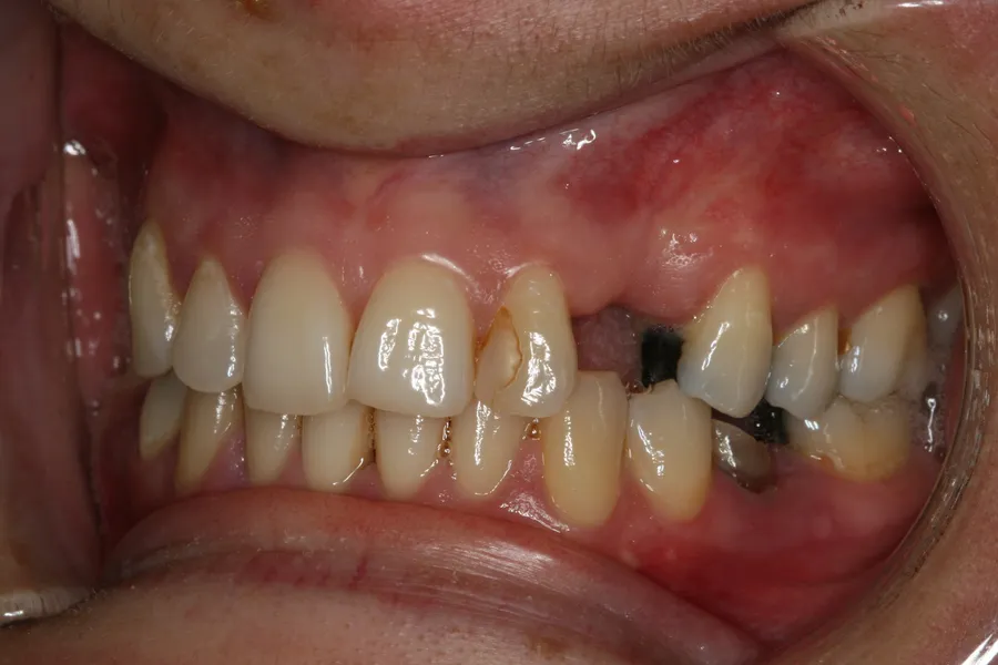 Retracted view, before: Missing Cuspid Replaced: Hailey