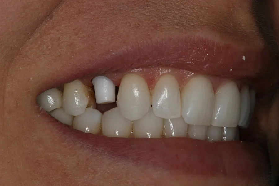Zirconia abutment in place: Implant + Esthetic Crown: Janissa